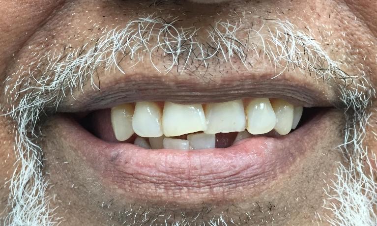 Damaged and crooked front teeth before photo