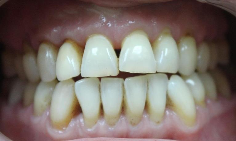 Before gaps in upper teeth