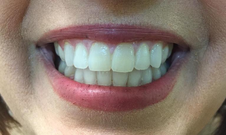 Mildly stained and yellowed teeth before whitening in Royal Palm Beach
