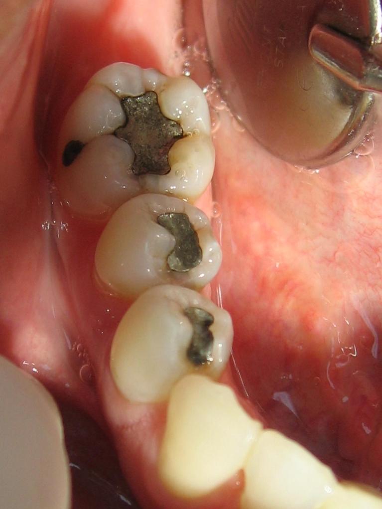 Old silver fillings before new dental filling