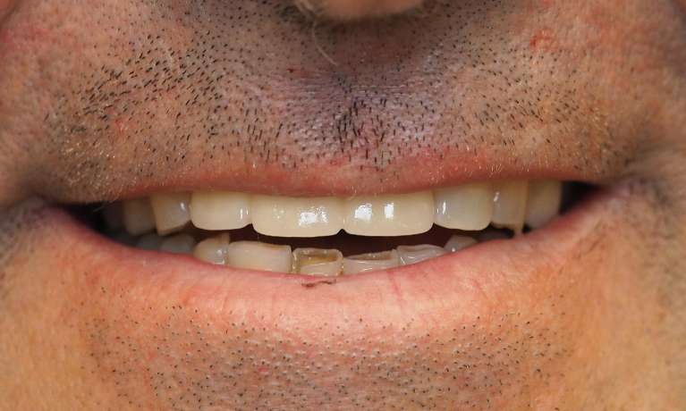 Implant-Bridge-After-Image