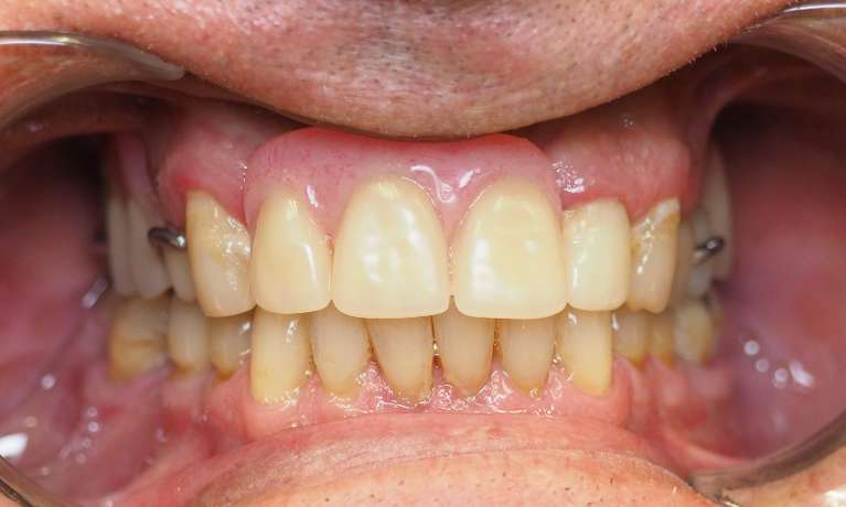 Partial Dentures Before and After | After Dentures