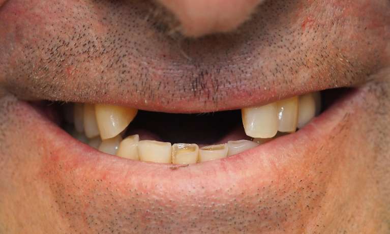 Implant-Bridge-Before-Image