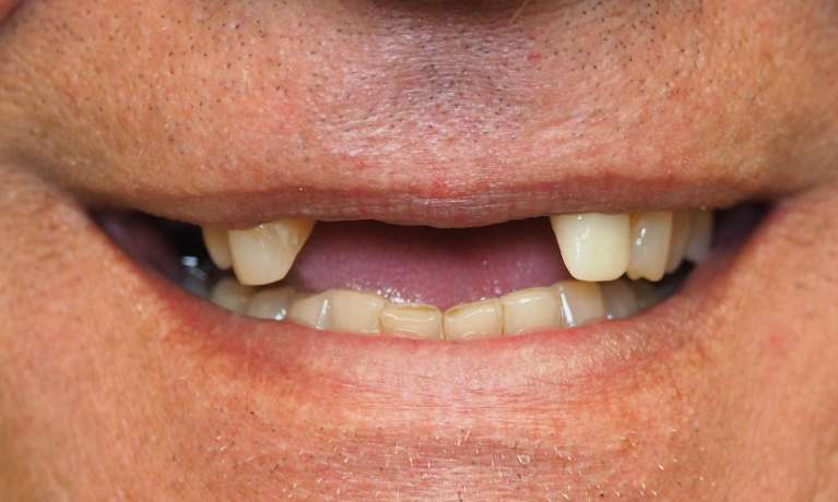 Partial Dentures Before and After | Before Dentures